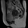 Adenomyosis and endometriotic cysts (Radiopaedia 82300-96367 Sagittal T2 7).jpg