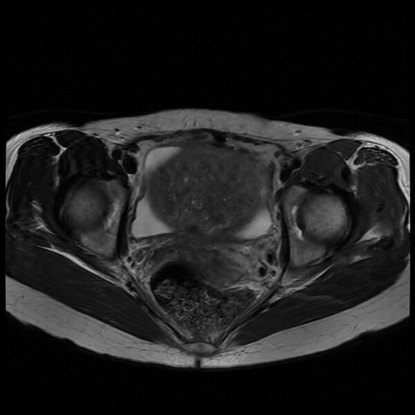File:Adenomyosis on MRI (Radiopaedia 29328-29780 Axial T2 8).jpg