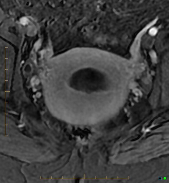 File:Adenomyosis uterus with hematometra (Radiopaedia 45779-50011 Axial T1 C+ fat sat 39).jpg