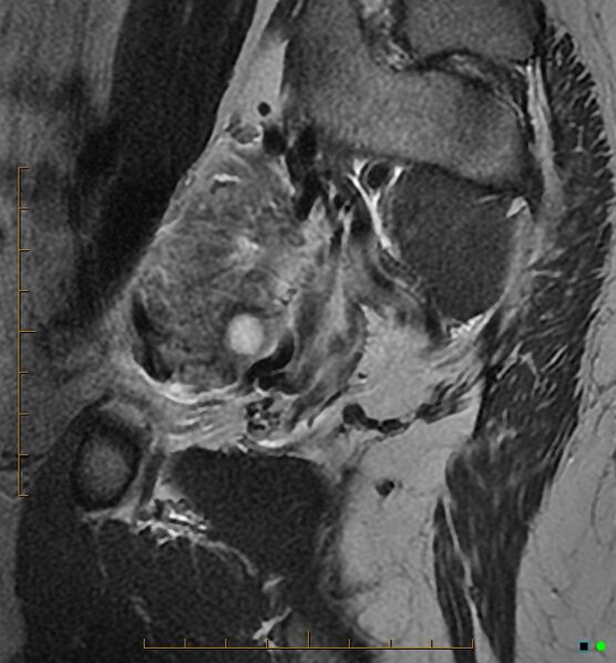 File:Adenomyosis uterus with hematometra (Radiopaedia 45779-50011 Sagittal T2 4).jpg