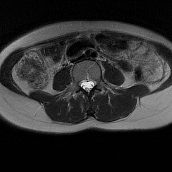 File:Adenomyosis within a septate uterus (Radiopaedia 69963-79981 Axial T2 1).jpg