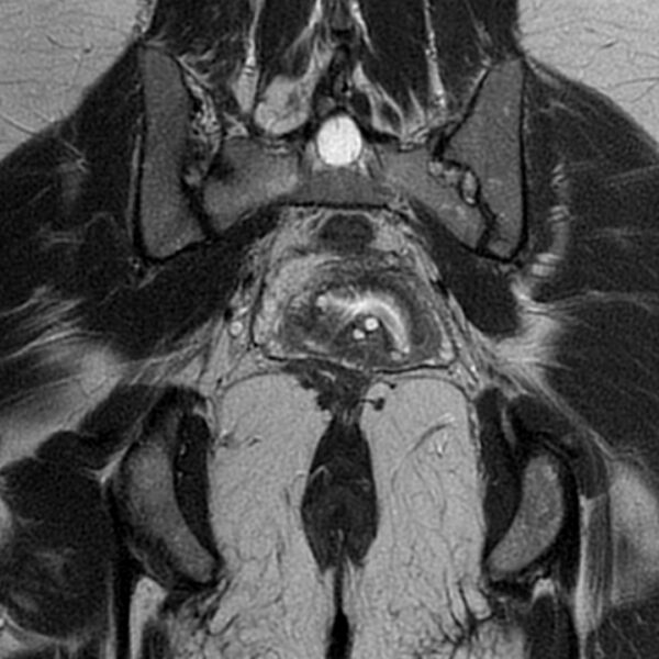 File:Adenomyosis within a septate uterus (Radiopaedia 69963-79981 Coronal T2 26).jpg