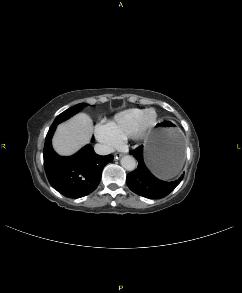 Adhesional small bowel obstruction (Radiopaedia 85402-101024 Axial C+ portal venous phase 23).jpg