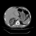 Adrenal myelolipoma (Radiopaedia 41843-44834 Axial non-contrast 12).jpg
