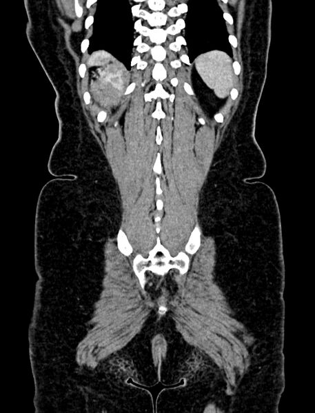 File:Adrenocortical carcinoma (Radiopaedia 87281-103569 Coronal C+ portal venous phase 135).jpg