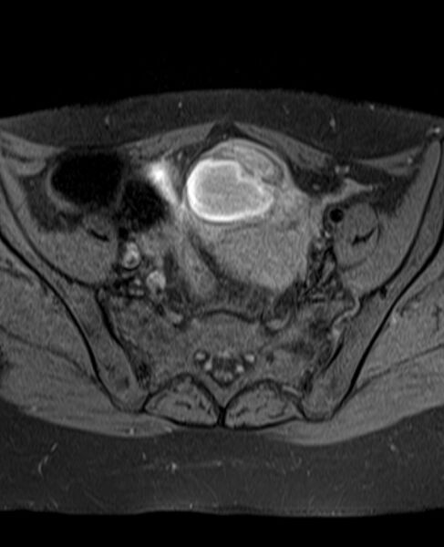File:Adult granulosa cell tumor of the ovary (Radiopaedia 71581-81950 Axial T1 fat sat 10).jpg