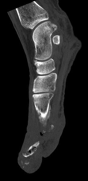 File:Advanced osteomyelitis due to open metatarsal fracture (Radiopaedia 83891-99095 C 6).jpg