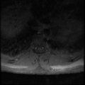 Aggressive vertebral hemangioma (Radiopaedia 39937-42404 Axial T1 C+ fat sat 14).png
