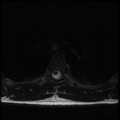 Aggressive vertebral hemangioma (Radiopaedia 39937-42404 Axial T2 27).png