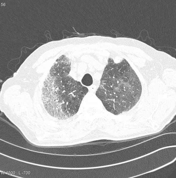 File:Amiodarone lung (Radiopaedia 6539-7851 Axial lung window 5).jpg