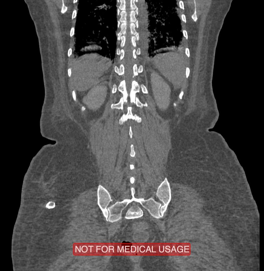 Amoebic enterocolitis with liver abscess (Radiopaedia 35100-36609 B 174).jpg