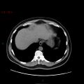 Ampullary carcinoma (Radiopaedia 56396-63056 Axial non-contrast 8).jpg