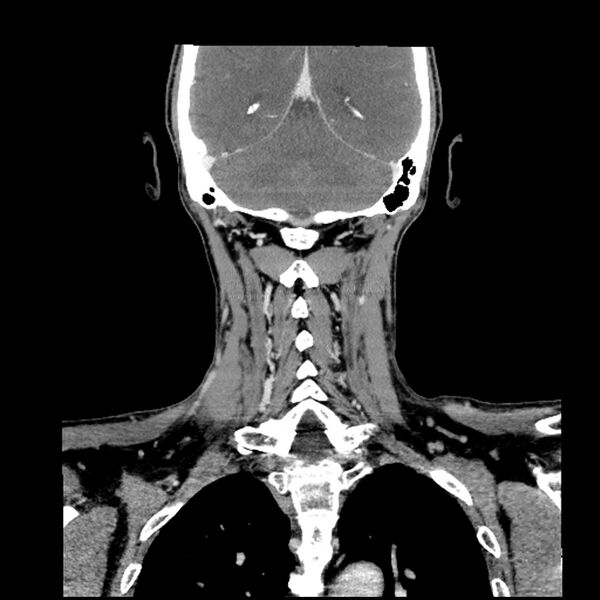 File:Anaplastic thyroid carcinoma (Radiopaedia 79087-92034 A 88).jpg