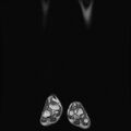 Aneurysmal bone cyst - tibia (Radiopaedia 22343-22367 Coronal T1 1).jpg
