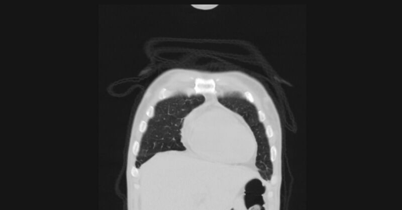 File:Angioinvasive aspergellosis (Radiopaedia 66995-76315 Coronal lung window 7).jpg