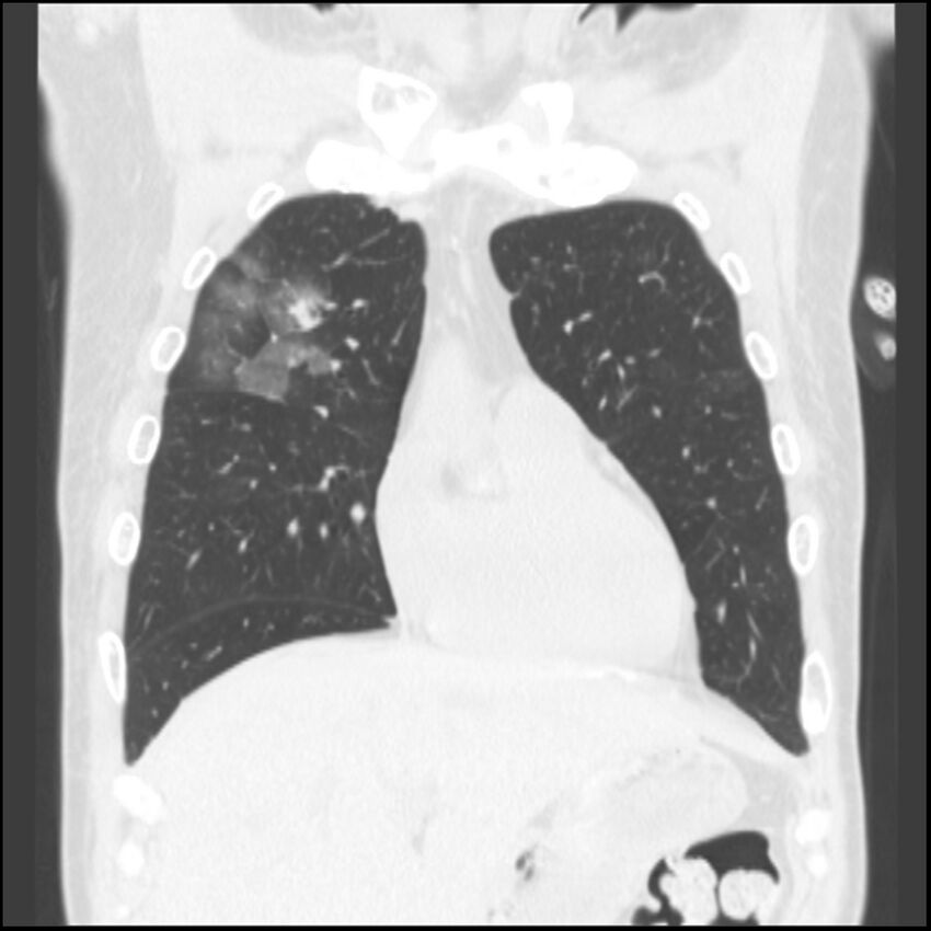 Angioinvasive aspergillosis (Radiopaedia 43957-47466 Coronal lung window 68).jpg
