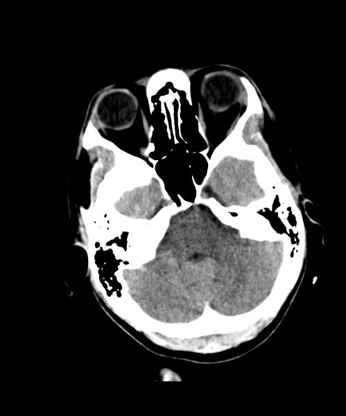 File:Angiomatous meningioma (Radiopaedia 79459-92578 Axial non-contrast 8).jpg