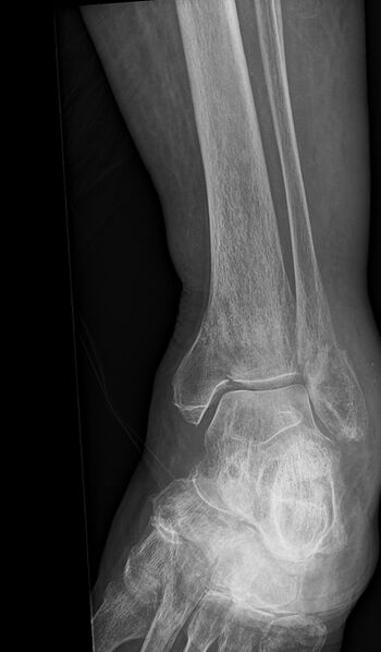 File:Ankle and metatarsal fracture - satisfaction of search (Radiopaedia 79231-92240 Frontal 1).jpg