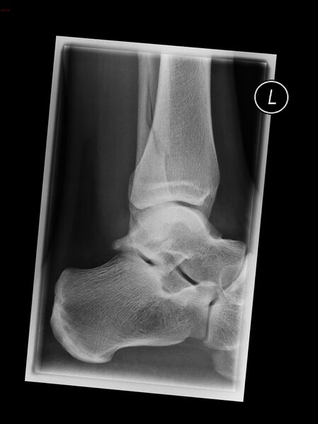 File:Ankle fracture - Weber C (Radiopaedia 15758).jpg