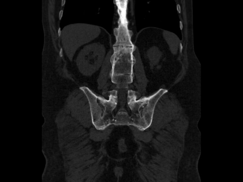 File:Ankylosing spondylitis (Radiopaedia 44609-48357 Coronal bone window 67).jpg