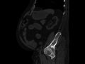 Ankylosing spondylitis (Radiopaedia 44609-48357 Sagittal bone window 80).jpg