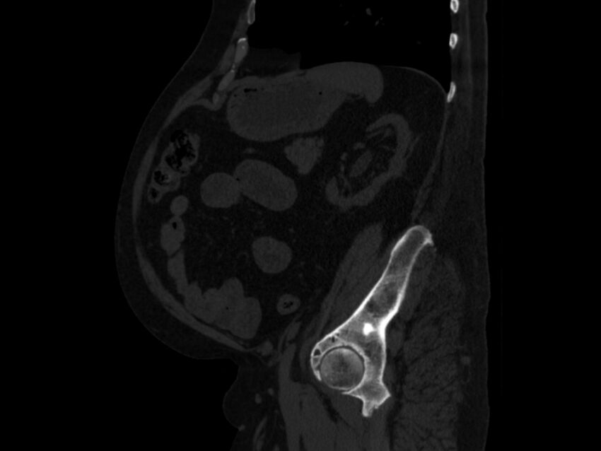 Ankylosing spondylitis (Radiopaedia 44609-48357 Sagittal bone window 80).jpg