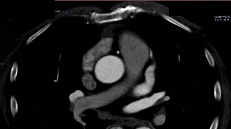 File:Anomalous left coronary artery- prepulmonic course (Radiopaedia 29253-29667 A 5).JPG