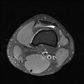 Anterior cruciate ligament full thickness tear (Radiopaedia 66268-75467 Axial PD fat sat 4).jpg