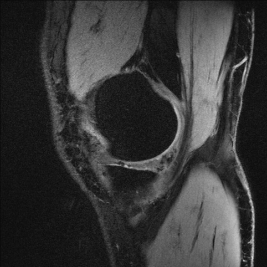 Anterior cruciate ligament mucoid degeneration (Radiopaedia 68400-77933 Sagittal 56).jpg