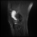 Anterior cruciate ligament tear with posteromedial corner injury, bucket-handle meniscal tear and chondral delamination (Radiopaedia 75501-86744 Sagittal PD fat sat 25).jpg