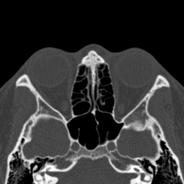 File:Antrochoanal polyp (Radiopaedia 33984-35202 Axial bone window 50).jpg