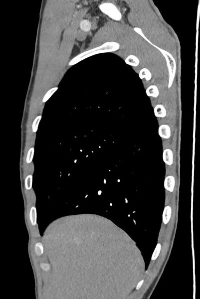 File:Aortic coarctation with aneurysm (Radiopaedia 74818-85828 B 34).jpg