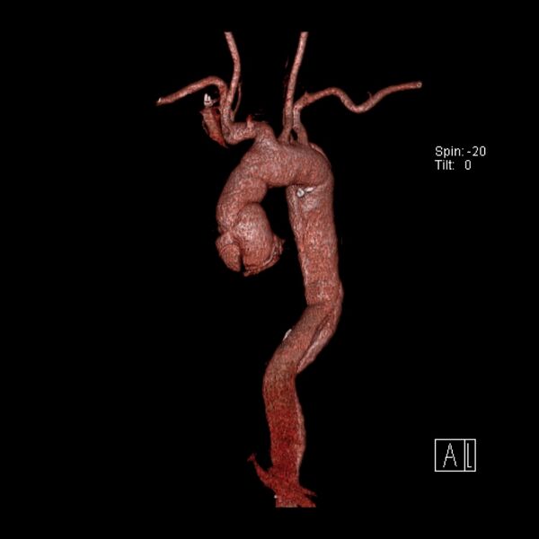 File:Aortic dissection - De Bakey type III - Stanford B (Radiopaedia 21903-21882 3D C+ arterial phase 18).jpg
