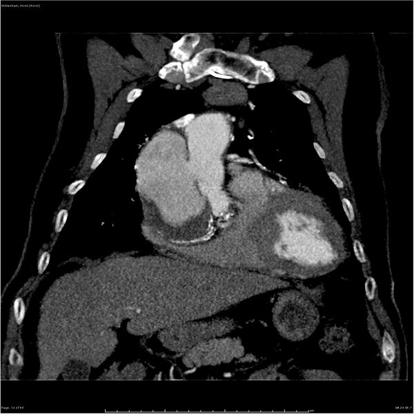 File:Aortic dissection - Stanford type A (Radiopaedia 26183-26315 A 11).jpg
