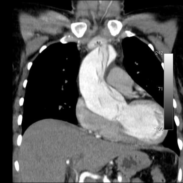 File:Aortic dissection - Stanford type A (Radiopaedia 29247-29659 B 23).jpg