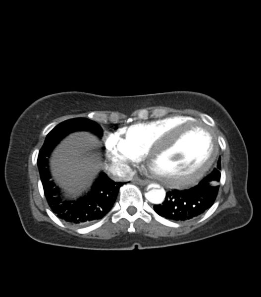 File:Aortic dissection with renal ischemia (Radiopaedia 76573-88338 A 50).jpg
