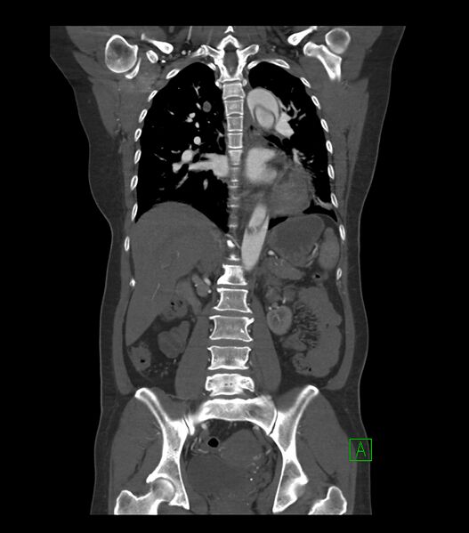 File:Aortic dissection with renal ischemia (Radiopaedia 76573-88338 C 20).jpg