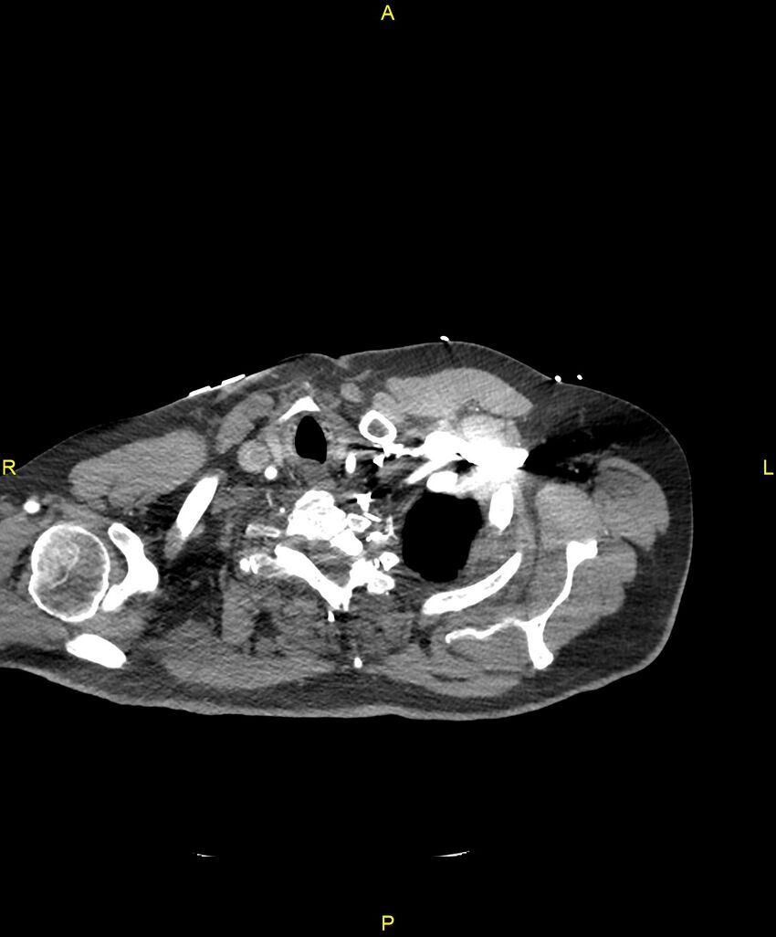 Aortic rupture (Radiopaedia 88822-105594 B 13).jpg