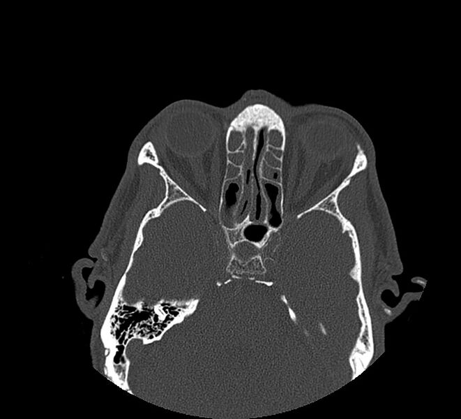 File:Aplastic maxillary sinuses (Radiopaedia 60030-67561 Axial non-contrast 49).jpg