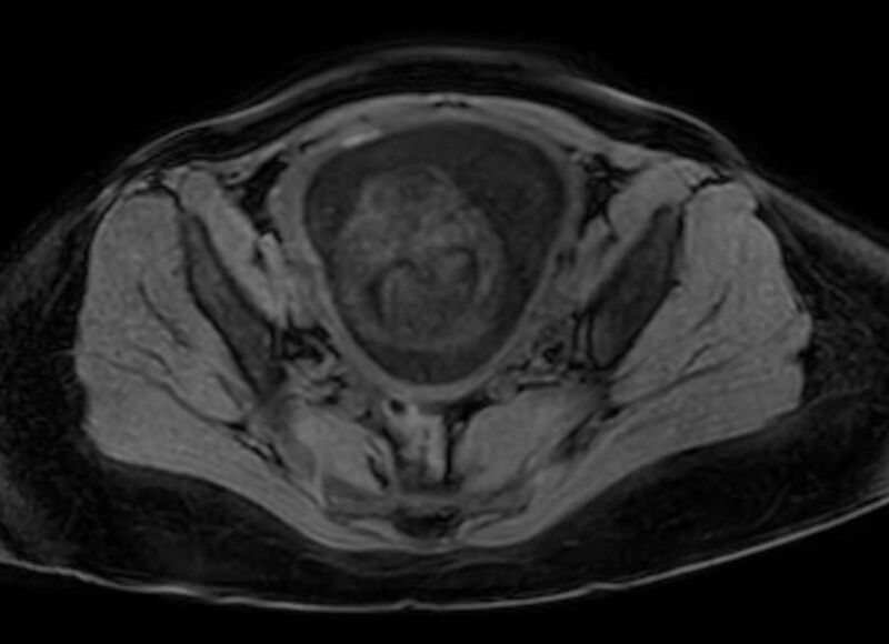 File:Appendicitis in gravida (MRI) (Radiopaedia 89433-106395 Axial DIXON 124).jpg