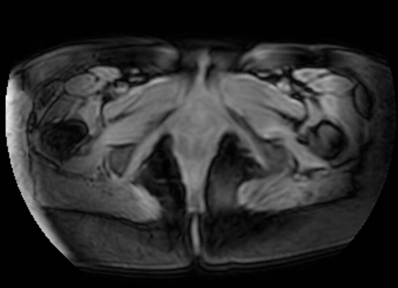 File:Appendicitis in gravida (MRI) (Radiopaedia 89433-106395 Axial DIXON 158).jpg