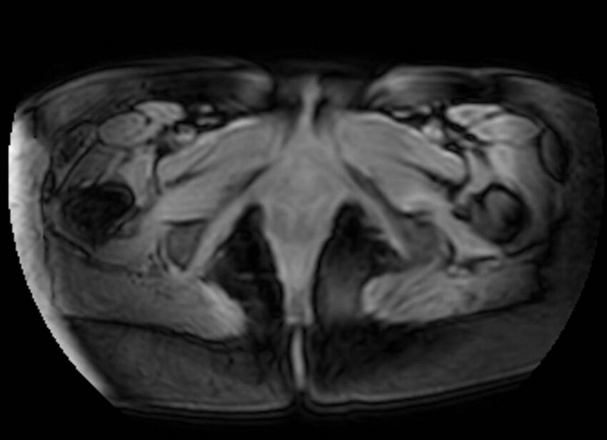 Appendicitis in gravida (MRI) (Radiopaedia 89433-106395 Axial DIXON 158).jpg