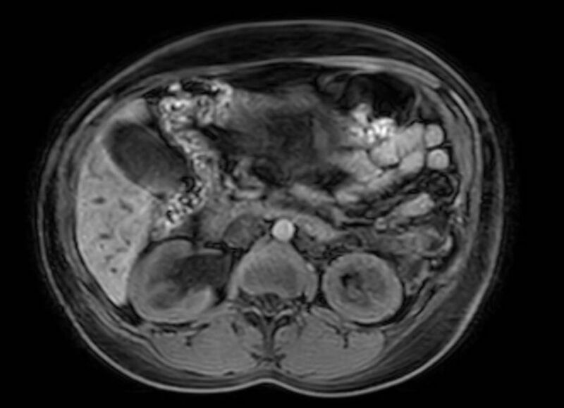 File:Appendicitis in gravida (MRI) (Radiopaedia 89433-106395 Axial DIXON 51).jpg