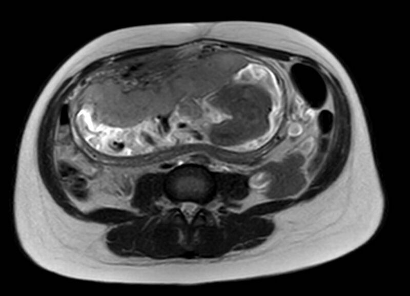 File:Appendicitis in gravida (MRI) (Radiopaedia 89433-106395 Axial T2 38).jpg