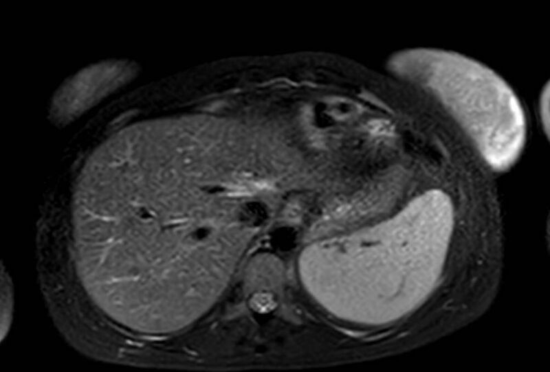 File:Appendicitis in gravida (MRI) (Radiopaedia 89433-106395 Axial T2 SPAIR 10).jpg