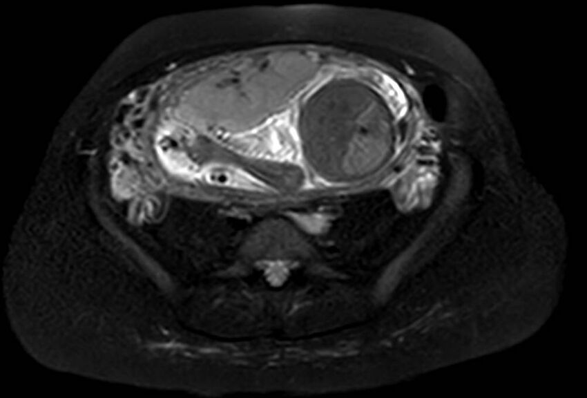 Appendicitis in gravida (MRI) (Radiopaedia 89433-106395 Axial T2 SPAIR 51).jpg