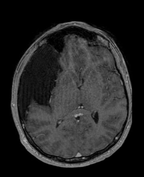 File:Arachnoid cyst- extremely large (Radiopaedia 68741-78451 Axial T1 C+ 42).jpg