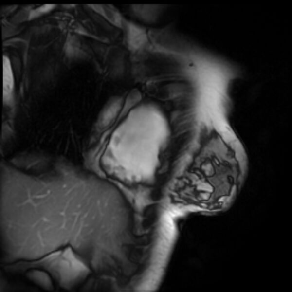 File:Arrhythmogenic right ventricular cardiomyopathy (Radiopaedia 87505-103850 2ch (RV) Cine SSFP 30).jpg