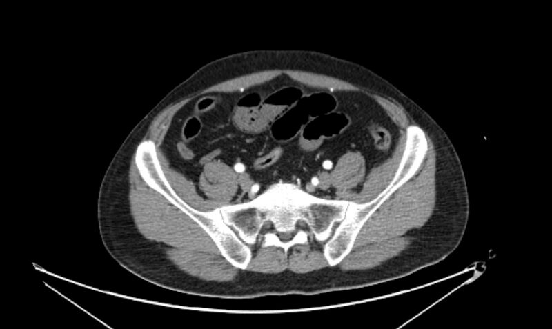 File:Arterial occlusive mesenteric ischemia (Radiopaedia 84641-100060 A 100).jpg