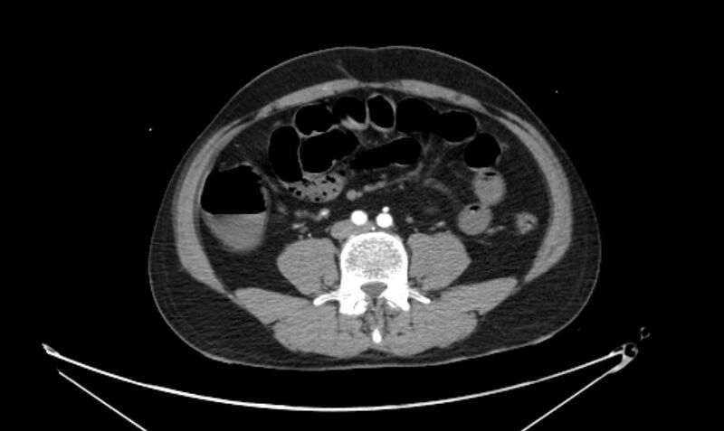 File:Arterial occlusive mesenteric ischemia (Radiopaedia 84641-100060 A 81).jpg